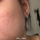 케어플러스메디칼(주) | 파주 운정피부관리 ‘드누에스테틱’ 재생관리 물방울LDM 재방문후기