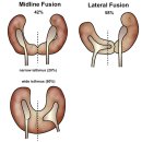 Horseshoe kidney 마제신 64/F 이미지