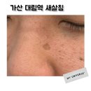 대상포진 패인흉터 가산 대림역 새살침 2주차 치료후기