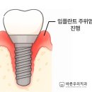 고려e치과의원 | 대구 태전동 치과 임플란트 재수술 어떤 경우에 해야 되나요?