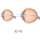 가성근시 (Pseudomyopia) 이미지