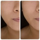 강서슈퍼(등1) | [마곡피부관리] 리숨에스테틱 , 슈퍼맥스 파워리프팅 솔직 후기