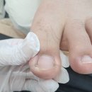 울산 내성발톱 관리 전문점 하이푸스 울산수암점