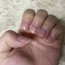 퓨오레 버블리페어 솔루션 사용 후기 :: 문제성발톱 필수템