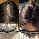 복신경외과의원 | 남성형 여성형 탈모 진단 치료 전문 병원 방문후기 제품추천