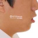 개방교합이 동반된 돌출입 치아교정 후기(발치교정)