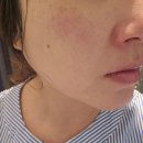 피코 | 다산 별내피부과 피코토닝 후기, 가격부터 효과까지 꼼꼼하게!