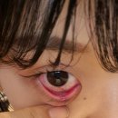 망포우리약국 | 눈다래끼 째기 고통 후기 / 째는 건 다시 한번 생각해 보세요