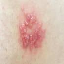 대상포진 진료 과정 치료 후기 :-) 30대 여자 과로, 스트레스