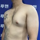 트루맨남성의원 | 트루맨 남성의원 강남점 여유증 수술 리얼 후기