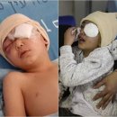팔레스타인 5세 어린이가 나블루스 시 근처에서 이스라엘 점령군의 총에 맞아 한쪽 눈을 잃습니다. 이미지