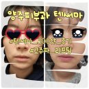 양주 옥정 피부과 텐써마 300샷 30대 고주파 리프팅 후기