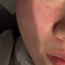 나음피부과의원 | [밴스의원 포텐자 2회차 후기] 😣어디가 제일 아프냐면...(통증 줄이기 꿀팁💡)