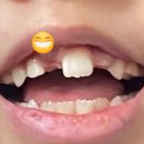 CDC | 아이 덧니 교정 후기(현재 진행 중..) cdc 어린이치과