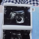 곰보분식 | ❤️임신 8주~9주차 증상,젤리곰시기,태교여행 임산부혜택TIP