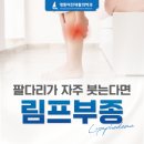 림프부종 초기증상, 놓치면 섬유화됩니다.
