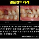 [광주임플란트] 광주임플란트 상악동 거상술과 함께 임플란트를 식립했어요 이미지