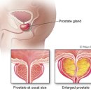 T12, L1,2, L4,5, L5-S1, SI joint syndrome --＞ 전립선 비대증상치료 이미지