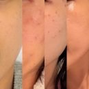 양청중학교 | 청주오창피부관리 | 오로라뷰티 오창점 톤업광채 색소침착관리 후기