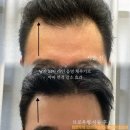 안산 남자 헤어라인 브로우씽 전후 사진 후기 / 헤어라인 가격