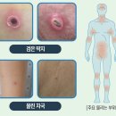 10~11월 쯔쯔가무시 조심하세요 이미지