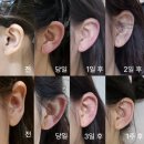 요정귀 누운귀필러 통증, 부작용 괴사 붓기 테이프 후기 - 압구정 피부과
