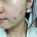 청주한의원 | 청주 성인여드름 치료 - 가경동 후한의원 내돈내산 후기