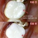 자이치과의원 | 재신경치료후기? 얼마나 갈아냈는지 크라운 표면만 봐도 보입니다