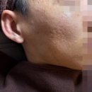 성남 분당 여드름 패인흉터 치료 후기 새살침 2회차