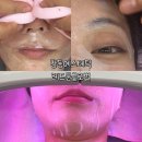 창동에스테틱ㅣ레드문글로벌에서 아큐포인트 제품으로 힐링 관리