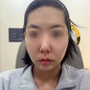 닥터디자이너의원명동점 | [공지] 사진 찍고 놀람... 실리프팅 일주일 후 얼굴 턱선 라인 변화 | 을지로입구역 피부과 솔직 후기