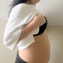 프로젝트 멍 | 신촌 복부 지방추출주사 당일 솔직 후기 / 통증·붓기·멍 기록