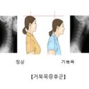 거북목 증후군 (Turtle neck syndrome) 이미지