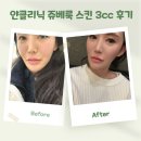 진스킨의원 | 얀클리닉 쥬베룩 스킨 3cc 내돈내산 후기 !