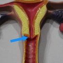 불임 다음으로 힘든 자궁경부무력증으로 실비보험 이미지