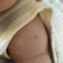 다나소아과 | 대구 피내용 bcg 접종 후기 다나소아과