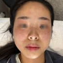 디스이즈약국 | 따끈따근. 기미,주근깨 아웃. 루비레이져 538방 맞은 썰푼다.