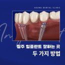 청주 임플란트 잘하는곳? 두 가지만 확인해 보세요