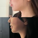 길면각 | 청담 피부과 텐쎄라 V라인 리프팅 후기 (가격, 통증, 효과)