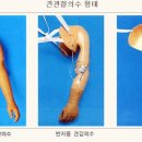 현대의수족 네이버블로그