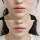 3쓰리 | 홀드랩 써마3 써마쓰리 리프팅 이중턱 사각턱 관리 솔직 후기!