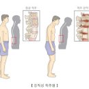 강직성 척추염 원인 증상 치료 이미지