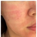 명동2호점밴스의원 | 밴스의원 명동피부과 2호점 : 포텐자 스킨부스터 후기