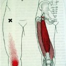 근막동통증후군 (Myofascial Pain Syndrome) 이미지