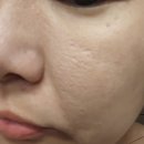 라셀 | 신사역 비올라셀성형외과 쥬베룩 스킨 나비존 모공 고민 일주일 차 후기