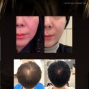 가연스킨케어 | 차세대 윤곽관리 솔루션 ‘ALTEON(알테온)’ 가연 코스메틱 임상