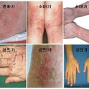 아토피성 피부염 (Atopic dermatitis) 이미지