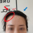 동원헤어라인 | 천안두피컨설팅 천안헤어라인컨설팅 불당동원썸뷰티 다녀온 솔직후기