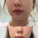 타이트짐 | 창원 피부과 올타이트 리프팅 300샷 내돈내산 솔직후기!