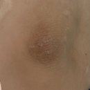 옥메디 | 멜라닌케어 받고 팔꿈치 밝아진 후기! 대전 유성 [더미미] 바디 미백관리, 색소침착개선 추천